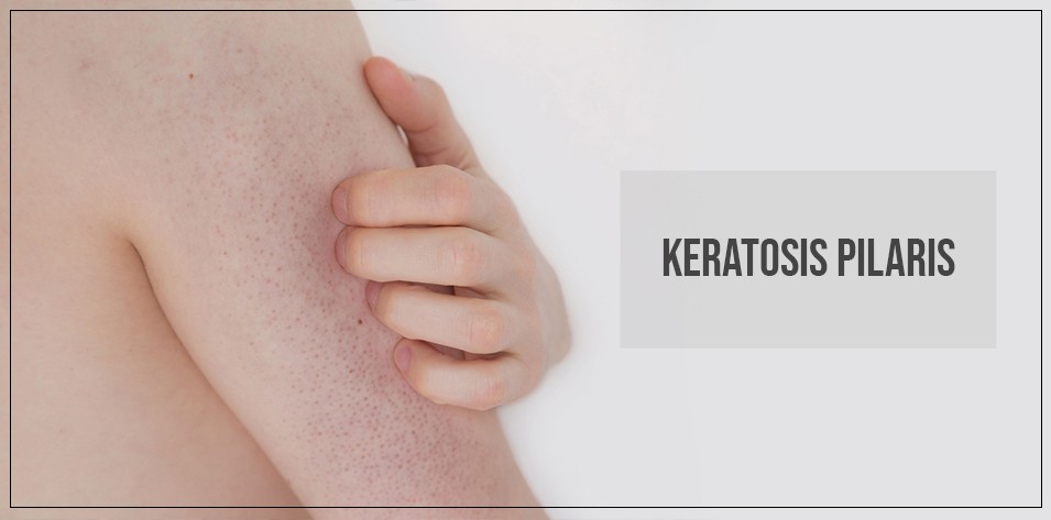 Keratosis pilaris 